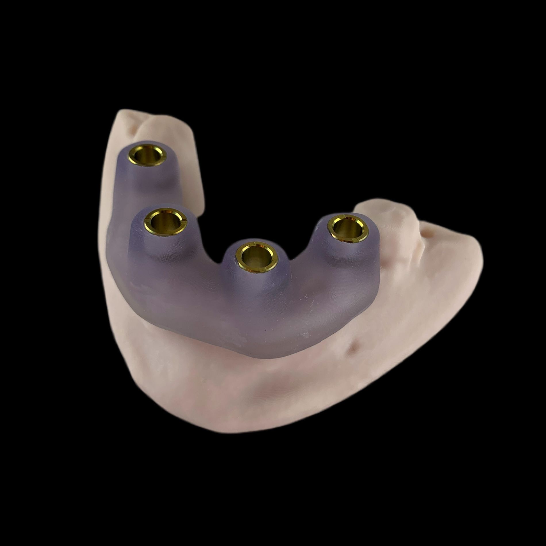 Alveolar crest supported guides